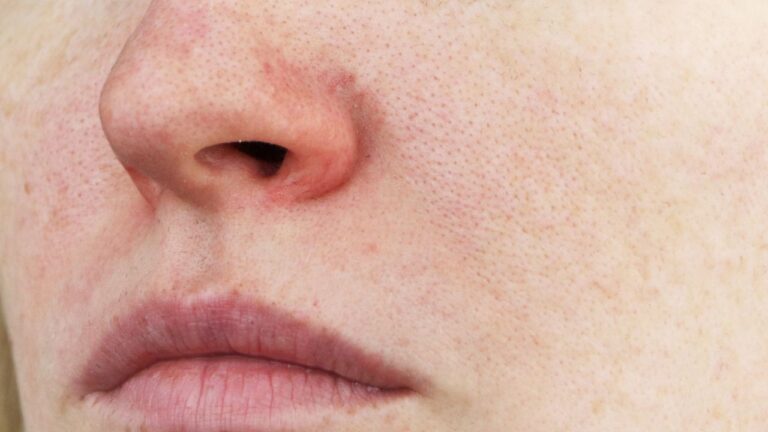 Nærbilde av en person med sprengte blodkar i ansiktet, synlige som tynne røde årer rundt nesevingene og kinnene. Bildet illustrerer hvordan sprengte blodkar kan oppstå i ansiktet og behandles med laser.