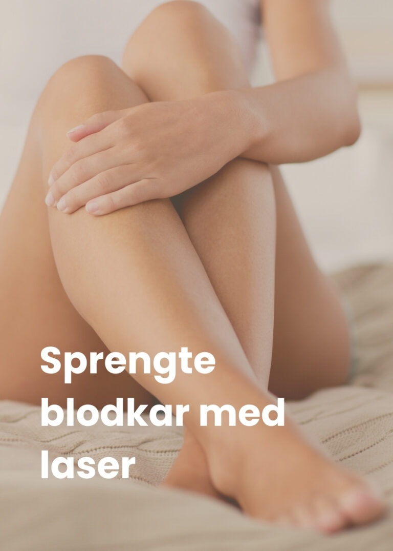 "Laserbehandling for fjerning av sprengte blodkar i ansikt og på ben hos Oslo Hudpleieklinikk Medispa."